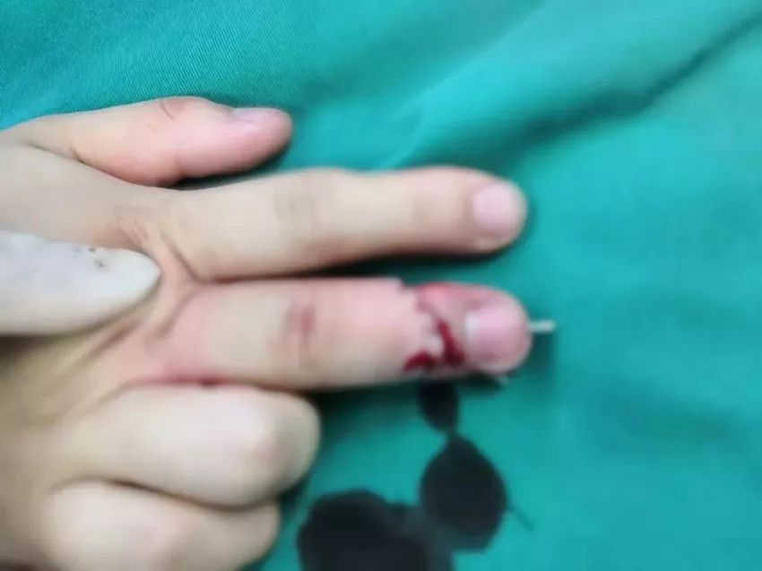 带戒指打保龄球什么意思